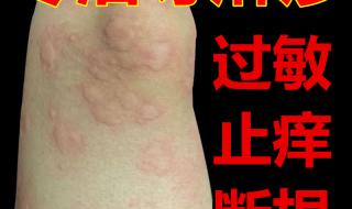 治疗慢性荨麻疹的药