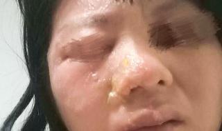 得带状疱疹必定有大病 得带状疱疹必定有大病